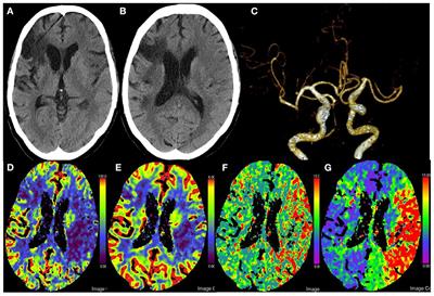 Mechanical thrombectomy for acute multivessel occlusions with duplicated middle cerebral artery: A case report